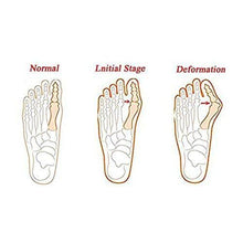 Load image into Gallery viewer, Bunion Splint Wrap - Corrector Brace ~ Big Toe Straightener
